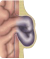 HernieEtranglee
