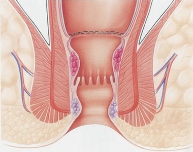 Anopexie par agrafage Dr Landen