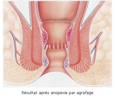 Anopexie par agrafage Dr Landen