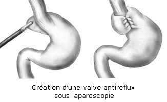 fig1 reflux