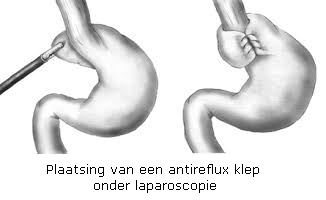 fig1 refluxNL