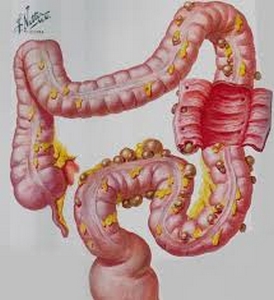 Diverticulose colique Dr Landen