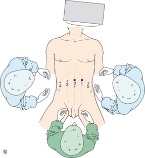 reflux1